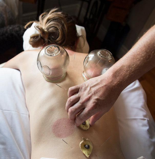 YINA Cupping TCM Treatments with Acupuncture and Herbal Moxibustion