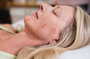 Woman receiving acupuncture on her face with red needles.