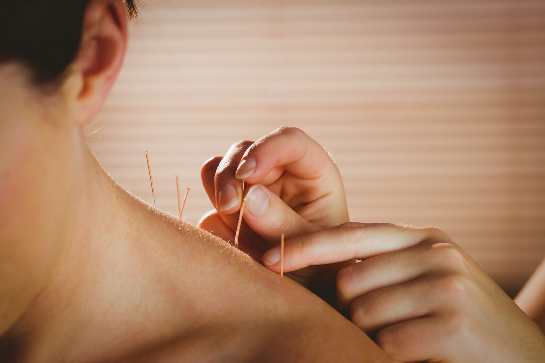 TCM Chinese Medicine Acupuncture Treatment